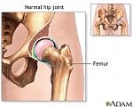 Click image for larger version

Name:	hip-joint-replacement-series.jpg
Views:	325
Size:	22.7 KB
ID:	55379
